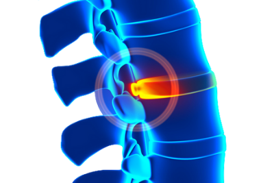 BLURB SPINAL DECOMP MIAMI